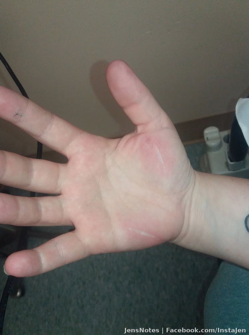 Flat ironing hair for many years. Today I tripped and landed on it at 450°! Ouch can't describe the 2nd possibly 3rd degree burns.