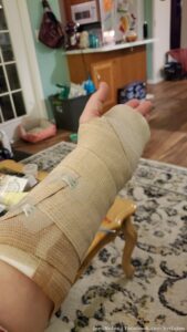 Local family will be happy to know I'm properly splinted by the hospital now. Long story but last Dec I passed out and my