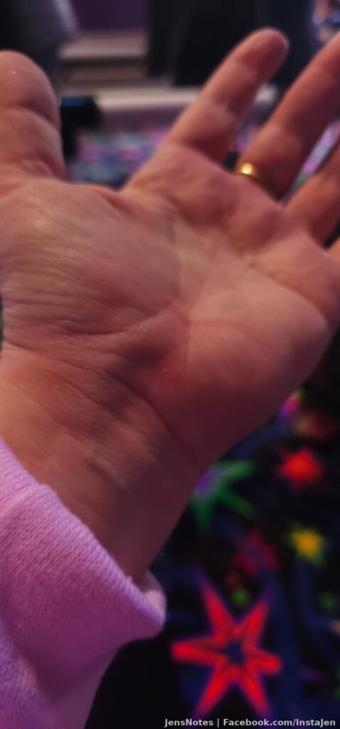 My 1st injury though I fell many times, a couple were epic so I will feel it tomorrow!